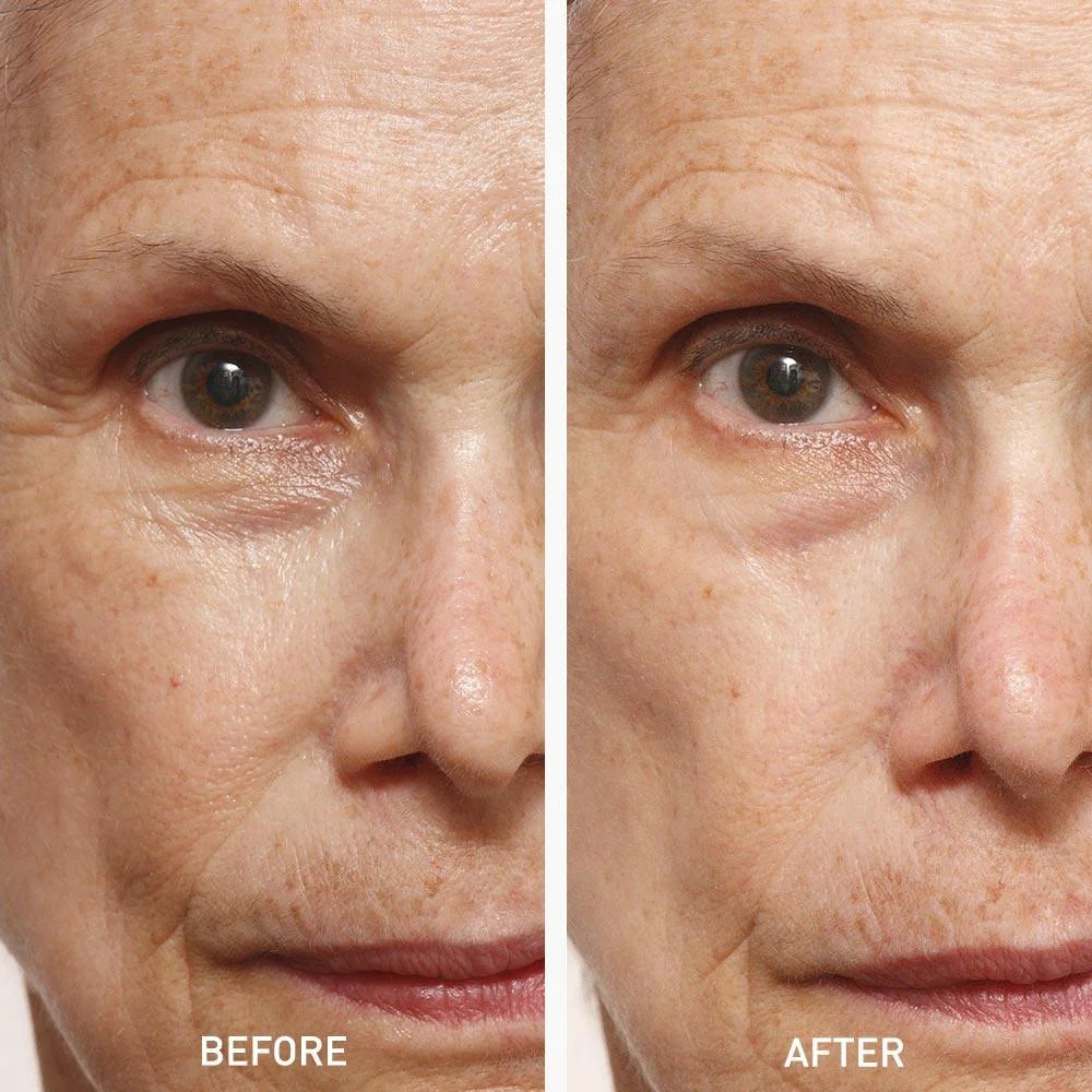 Before and After using Icelandic Relief Eye Cream - Visible reduction in puffiness, dark circles, and fine lines after using the eye cream with Icelandic glacial water, peptides, and antioxidants for a smoother, more refreshed appearance - Skyn Iceland